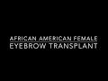 Ziering Medical AA Female Eyebrow Transplant