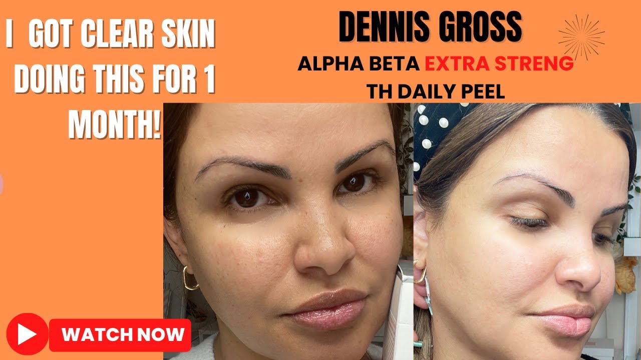 I FADED MY ACNE SCARS + GOT CLEAR SKIN DOING THIS FOR 1 MONTH!:dr ...