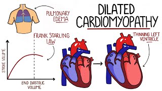 Dilated Cardiomyopathy Made Easy (DCM)