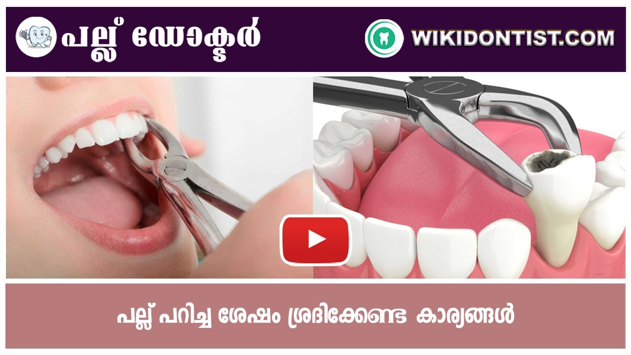 പല്ല് പറിച്ച ശേഷം  ശ്രദ്ധിക്കേണ്ട കാര്യങ്ങൾ/Things to look out for after Tooth Extraction