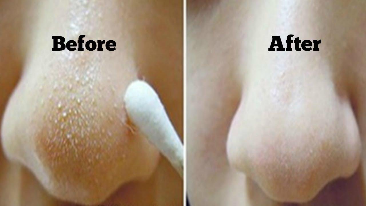 Cara Menghilangkan K0m3d0 Secara Cepat Dengan Baby Oil