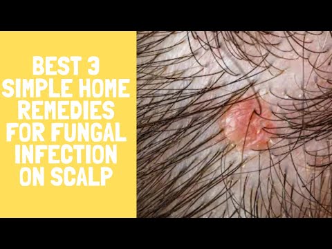 best-3-simple-home-remedies-for-fungal-infection-on-scalp(natural-home-remedy)