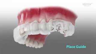 The Digital Sinus Surgery Kit, OneCas KIT