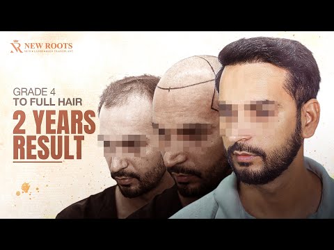 2 Years Later... Nobody Can Tell I Had a Hair Transplant! 😍 | Hair Transplant in Mumbai | New Roots