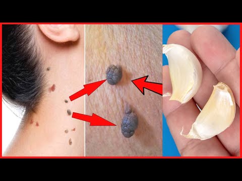 REMOVE SKIN TAGS INSTANTLY | AMAZING REMEDY FOR SKIN TAGS REMOVAL | HOW TO REMOVE SKIN TAGS