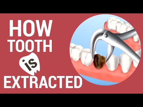 Teeth Extraction Rockville Centre, NY