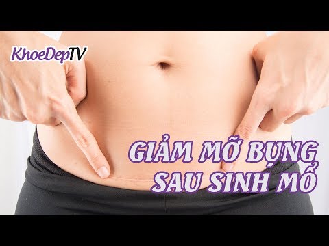 Video: Cách loại bỏ bụng sau sinh mổ tại nhà