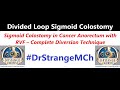 Part 1: Sigmoid Colostomy in Cancer Anorectum with RVF: Complete Diversion Tech. @saibharadwaj3897