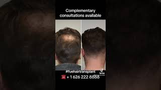 12 months update post hair restoration at 90% growth. #fue #hair #fuehairrestoration