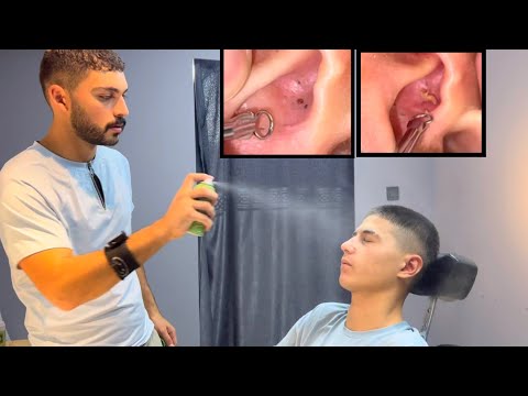 Blackhead and Acne Cleaning AD-FREE