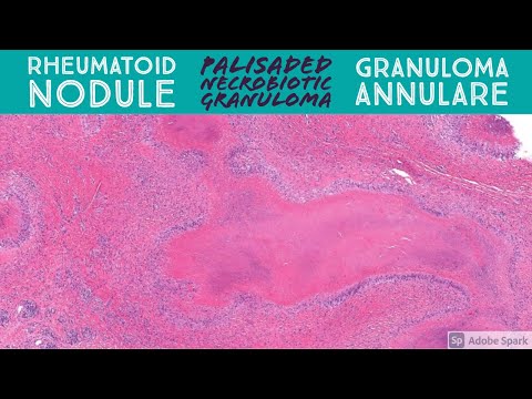 Rheumatoid Nodule &
