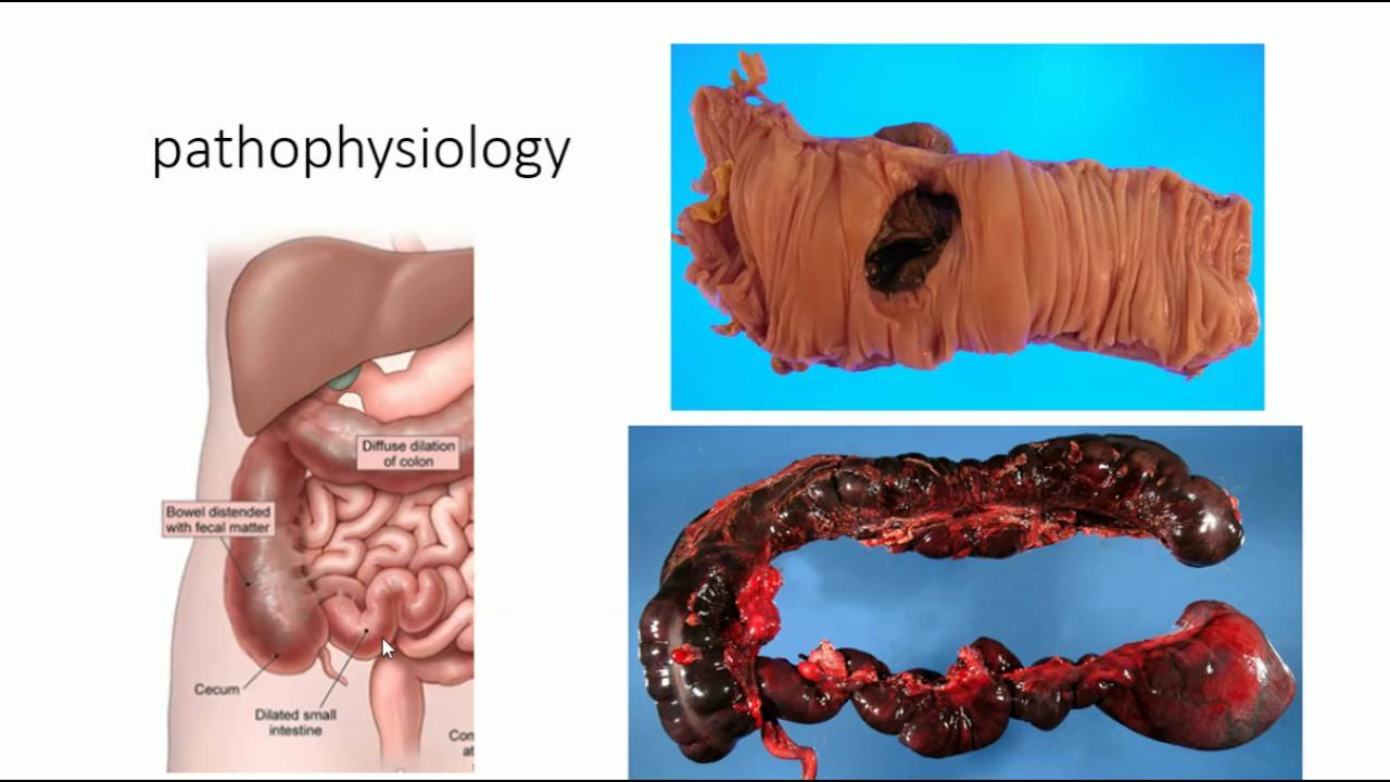 Tuberculos intestinales