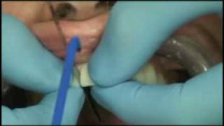 Dr. Dean Smile Makeover: Veneer Cementation