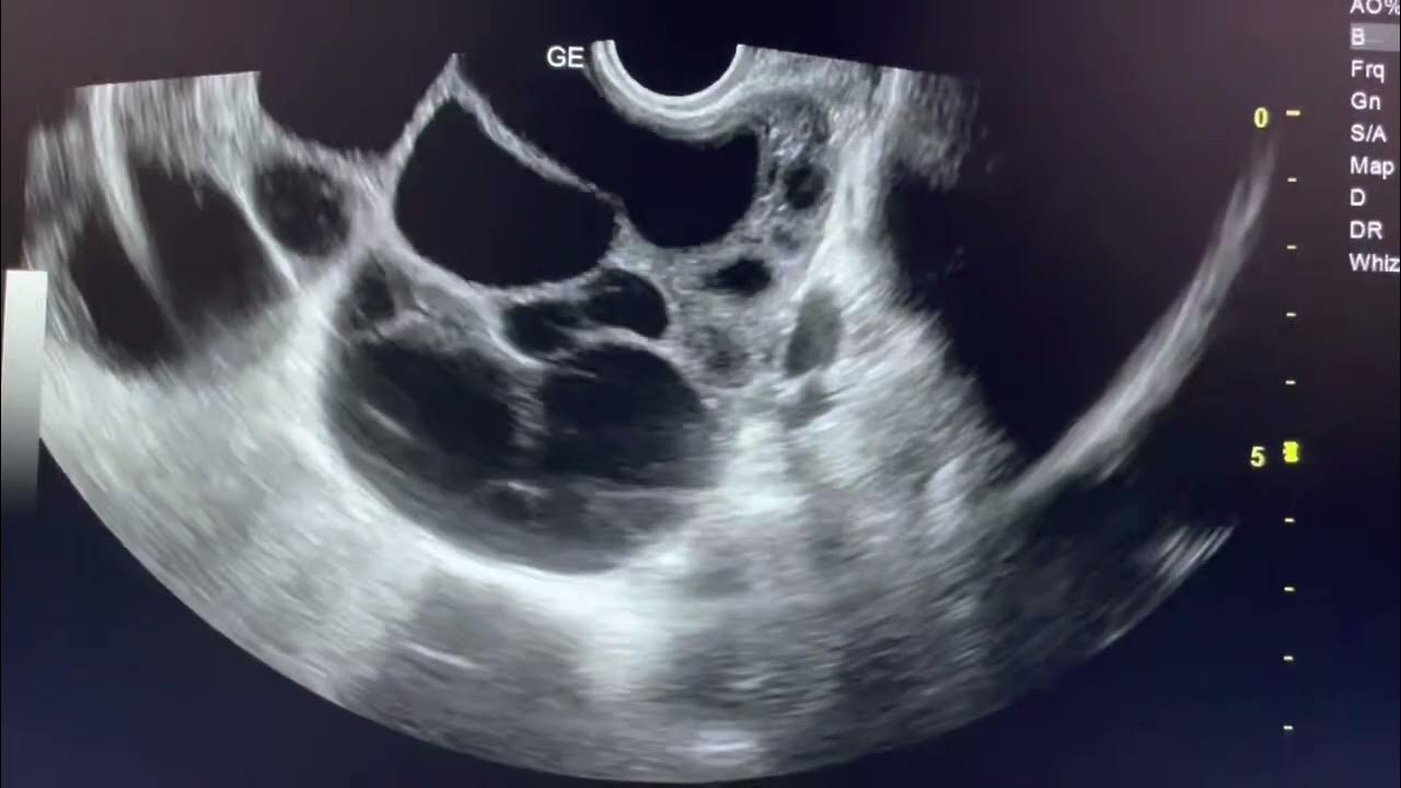 ovarian-hyperstimulation-syndrome-ultrasound-ovariancyst-sonography