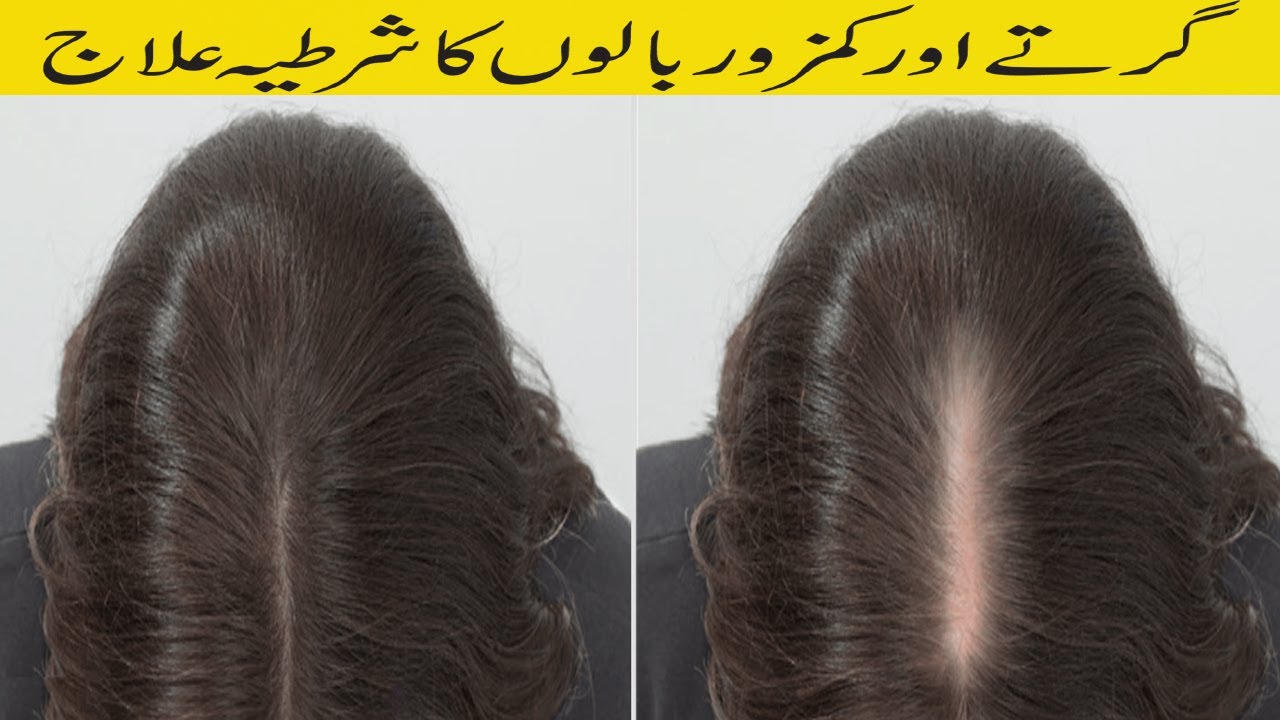 Onion Peel For Hair GrowthHair Growth TonerPyaz Ke Chilke Se Baal