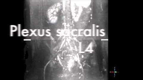 Imaging the Plexus Sacralis Movie