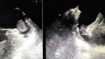 Left atrial appendage thrombus