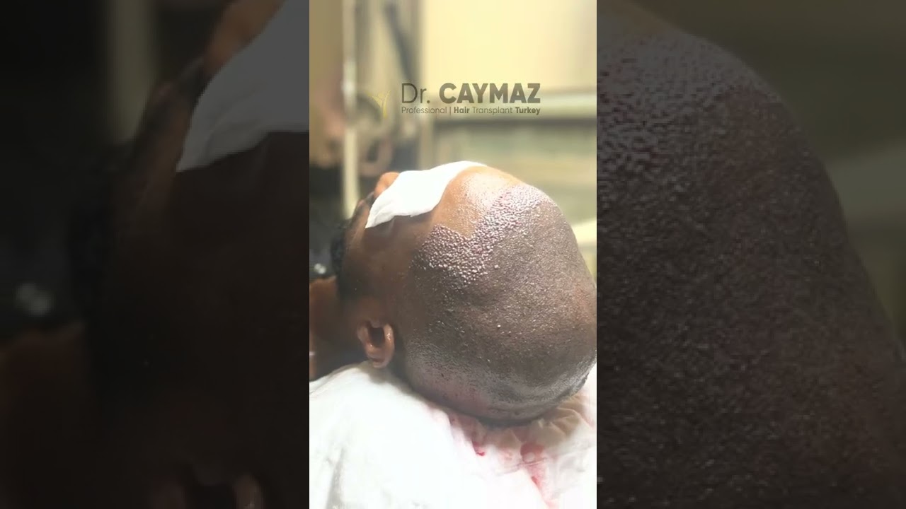 African-American Hair Implanted Grafts