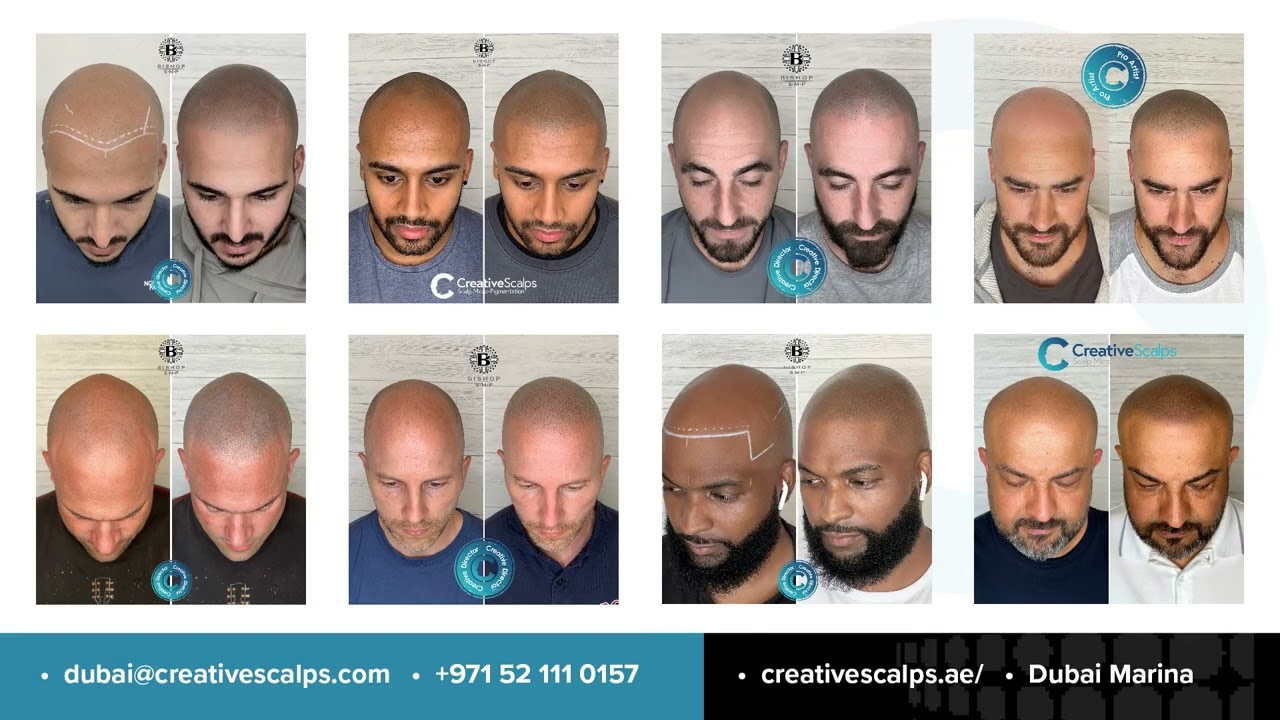 Scalp Micropigmentation | Creative Scalps Dubai