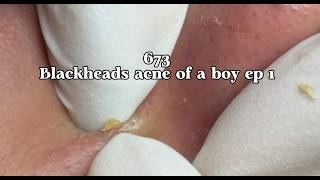 |673| Blackheads Acne of a boy ep1