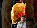 Fettleber: Wie überschüssiger Zucker Ihre Leber erstickt#FitnessFürMänner #Hormone #DrJonasStein