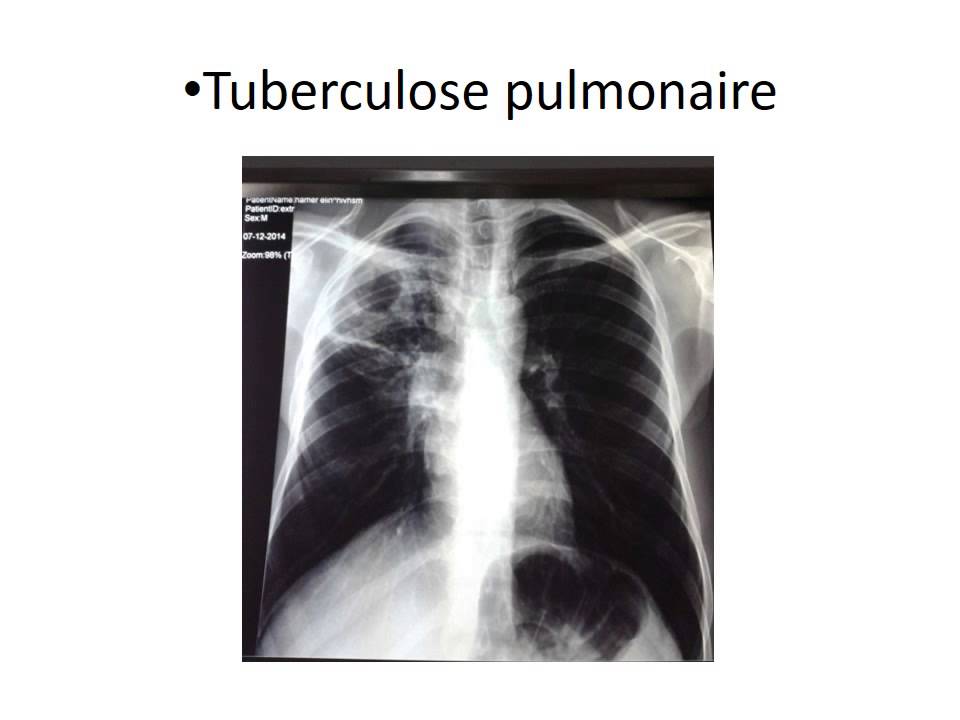 PNEUMOLOGIE abces du poumon 2016