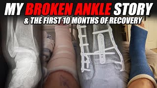 My Broken Ankle Story Trimaleollar Fracture