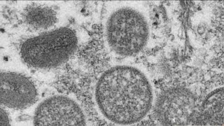 US declares public health emergency over monkeypox outbreak