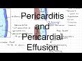 Pericarditis and Pericardial Effusion