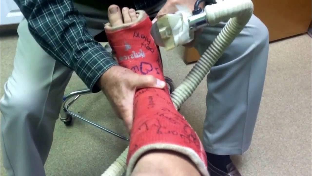 FINALLY GETTING MY CAST OFF!!! YouTube