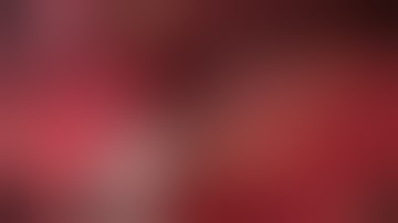 Asvide: Laparoscopic proximal gastrectomy with double tract reconstruction