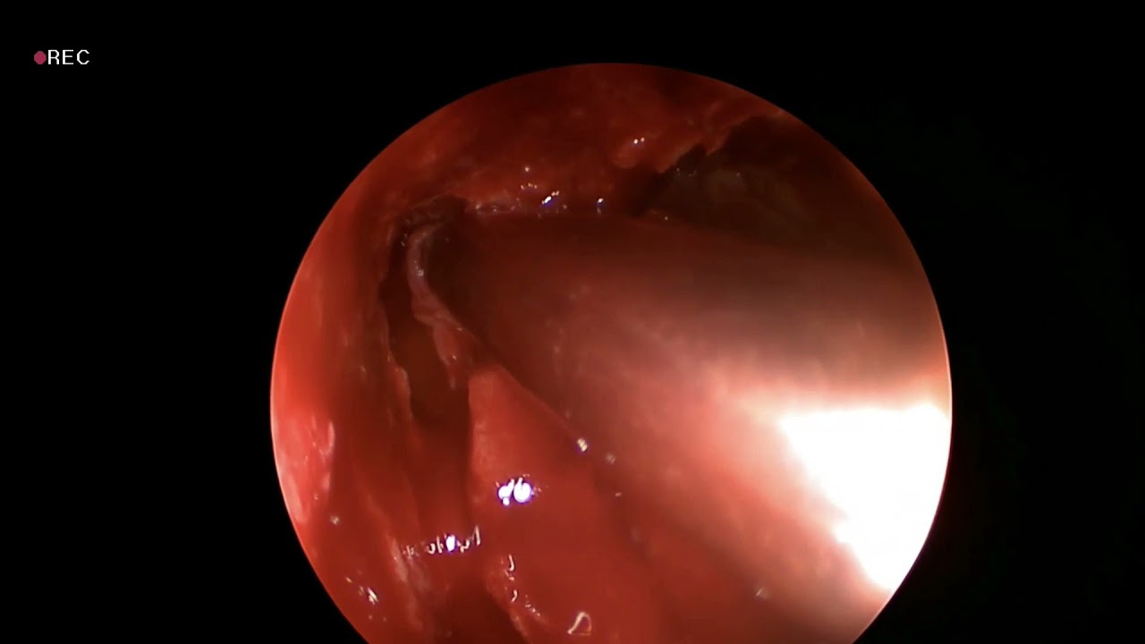 Revision endoscopic frontal sinus surgery. Modified Lothrop procedure. Draf 3.