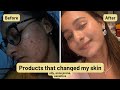 My Acne-Prone Skin Routine | What Finally Helped