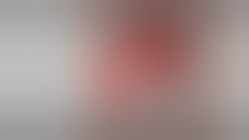 Segment IV resection (redo-hepatectomy)