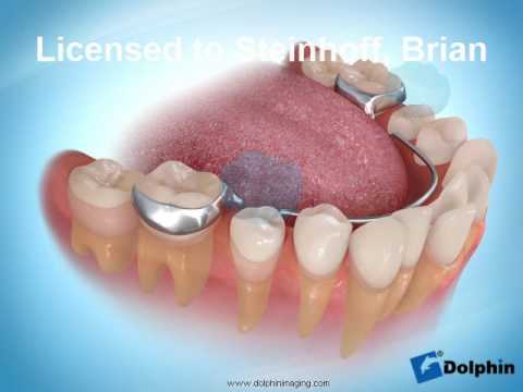 lower lingual holding arch