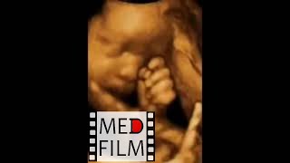 (Sh) 3D Ultrasound. 31 weeks pregnant. The kid scratches his nose © 3D УЗИ, 31 неделя беременности