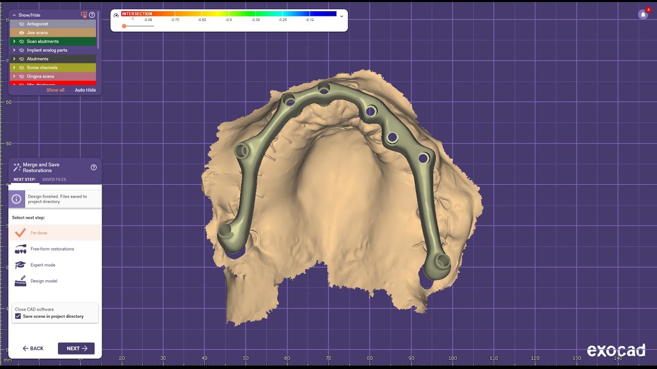 Bar designing for screw retained basal implant for full mouth replacement all on X in Exocad 3.2