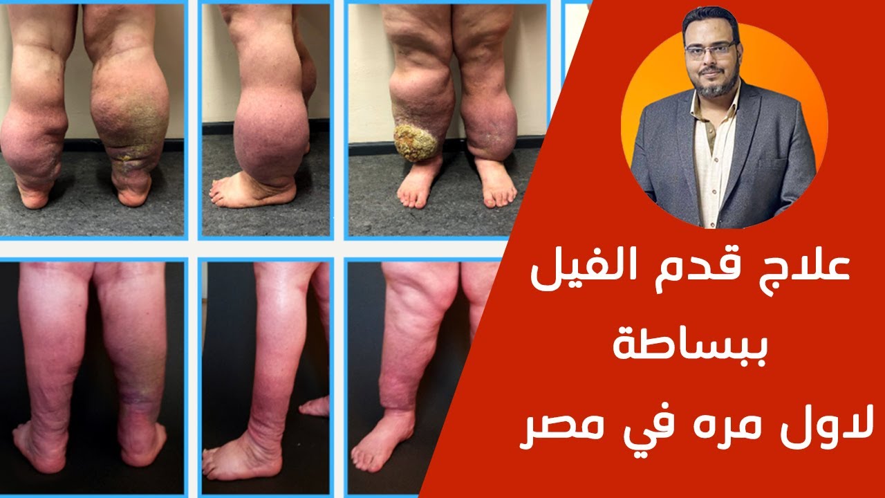 علاج داء الفيل في مصر | بادر بالعلاج بسرعه | الدكتور أحمد سمير