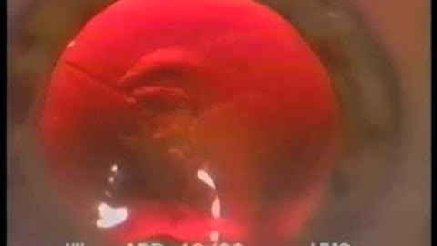 The Role of Viscoelastic in Cataract Surgery