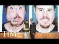 A Face Transplant Gave This 26-Year-Old A ‘Second Chance At Life’ | TIME