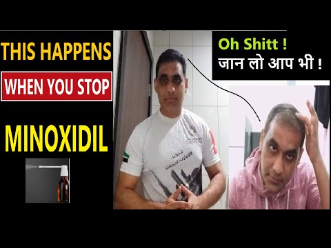 what-happens-to-your-hair-when-you-stop-using-minoxidil-in-hindi-|