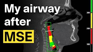 I Ran My Airway Through CFD… Here’s What It Revealed | Daniel Grafton #104 screenshot 3