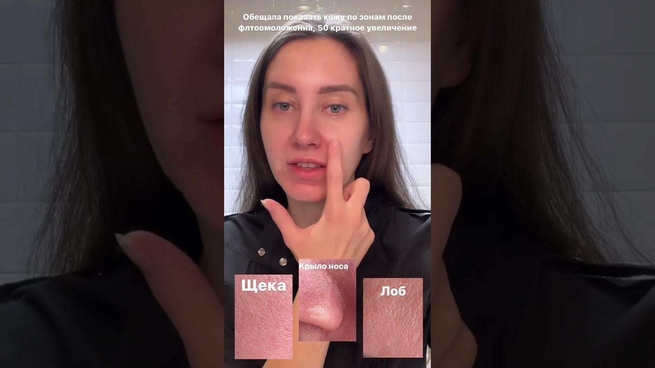 Эффект от IPL терапии, очень важно правильно подобрать параметры👌 