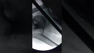 Proximal humerus fracture dislocation managed by ORIF with PHILOS