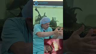 best way for wisdom Extraction with Dr Souheil Husseini I magnetic Mallet Osseotouch