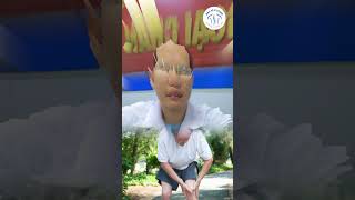 7 biến chứng thoái hoá khớp thường gặp