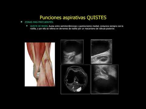 2019 tratamientos invasivos ecoguiados en rodilla