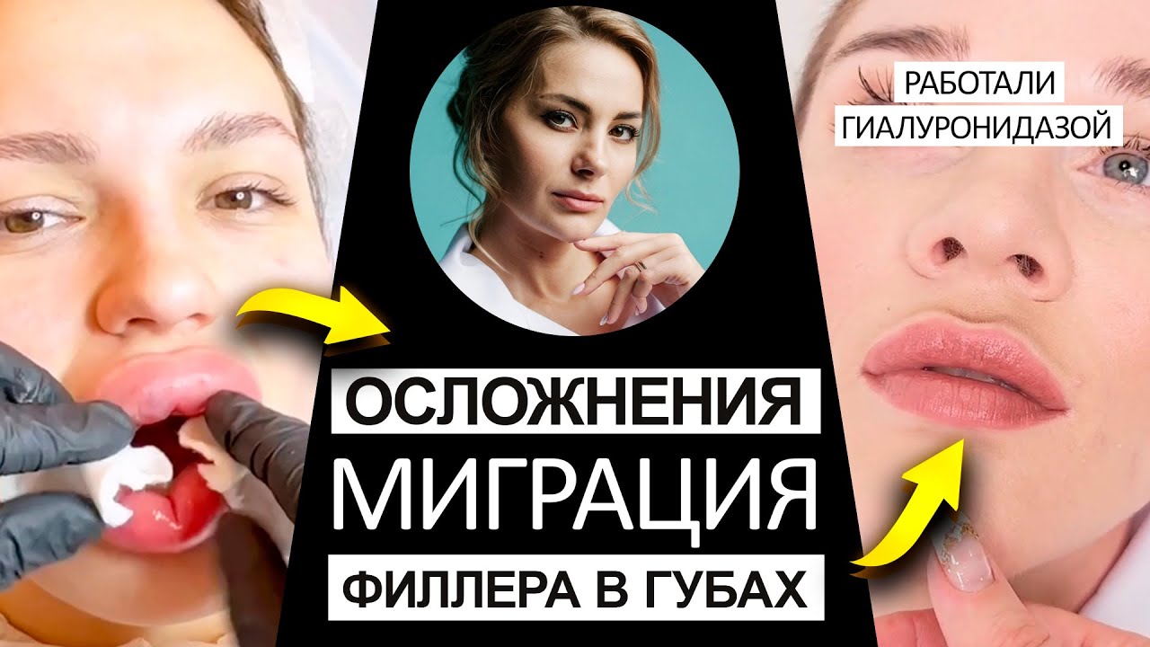 Как понять что филлер мигрировал. Миграция филлера в губах причины