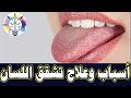 أسباب وعلاج تشقق اللسان