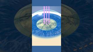 How does laser cataract surgery work? #shorts